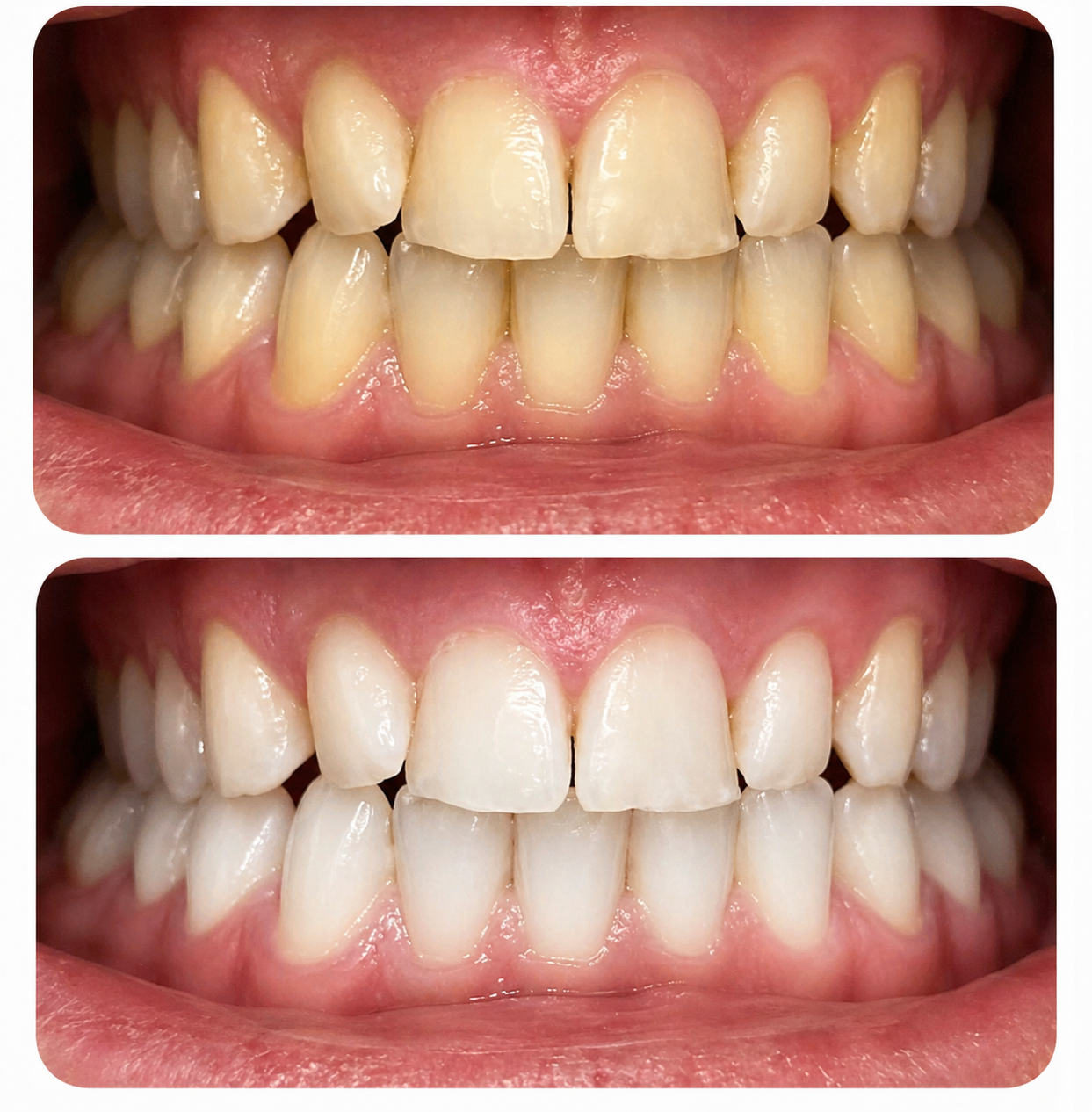 Blanqueamiento dental con férulas